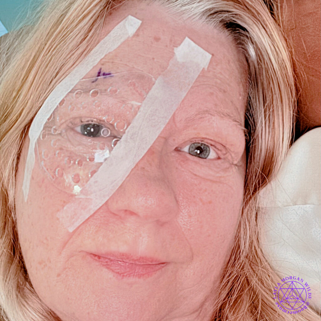 Cataract surgery